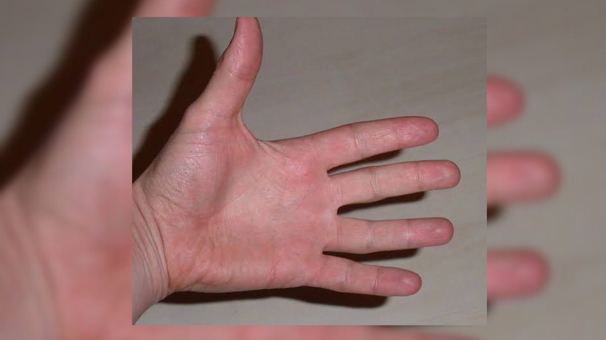 Non-local cook loses hand while making rotis at AIIMS Awantipora