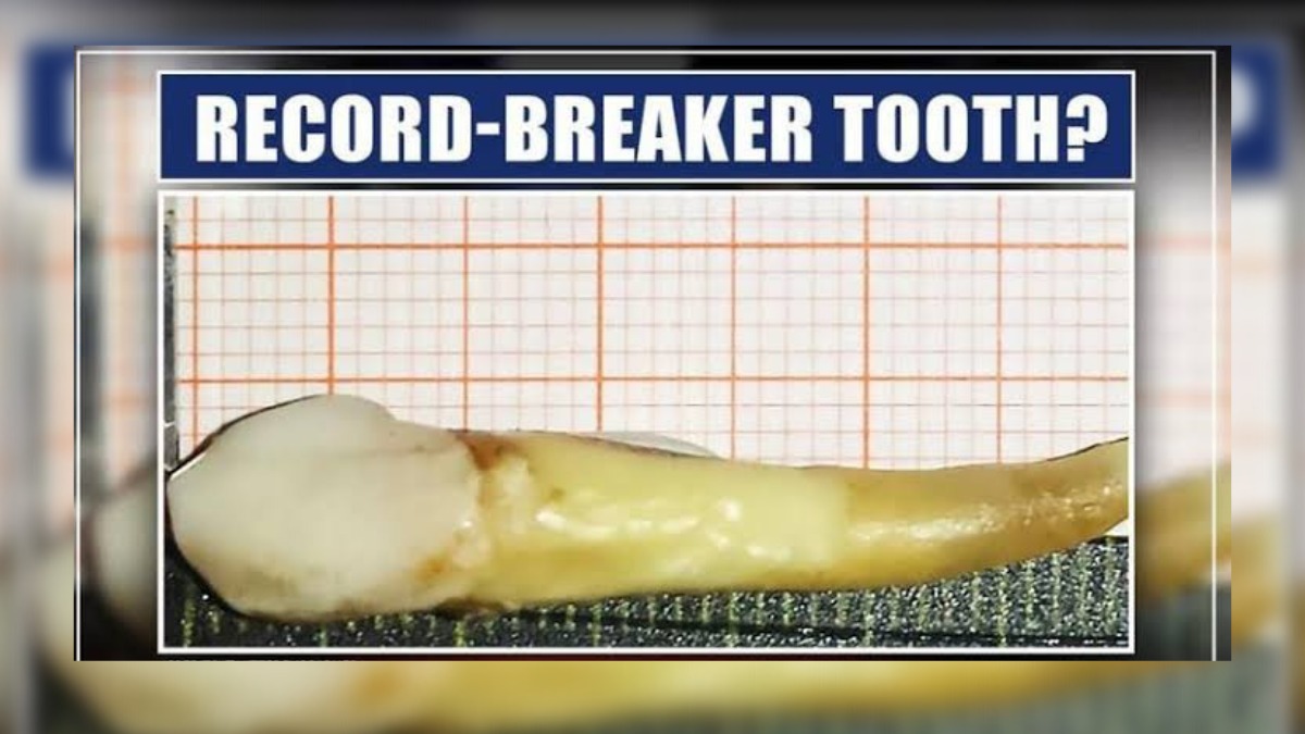 Doctors extract world's ‘longest’ tooth at SDH Beerwah, Budgam Doctors extract world’s ‘longest’  tooth at SDH Beerwah, Budgam