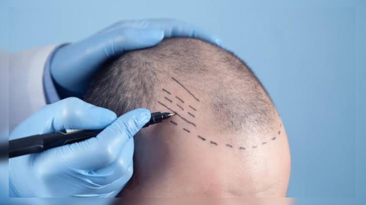 Man dies painful death after hair transplant goes wrong Man dies painful death after hair transplant goes wrong