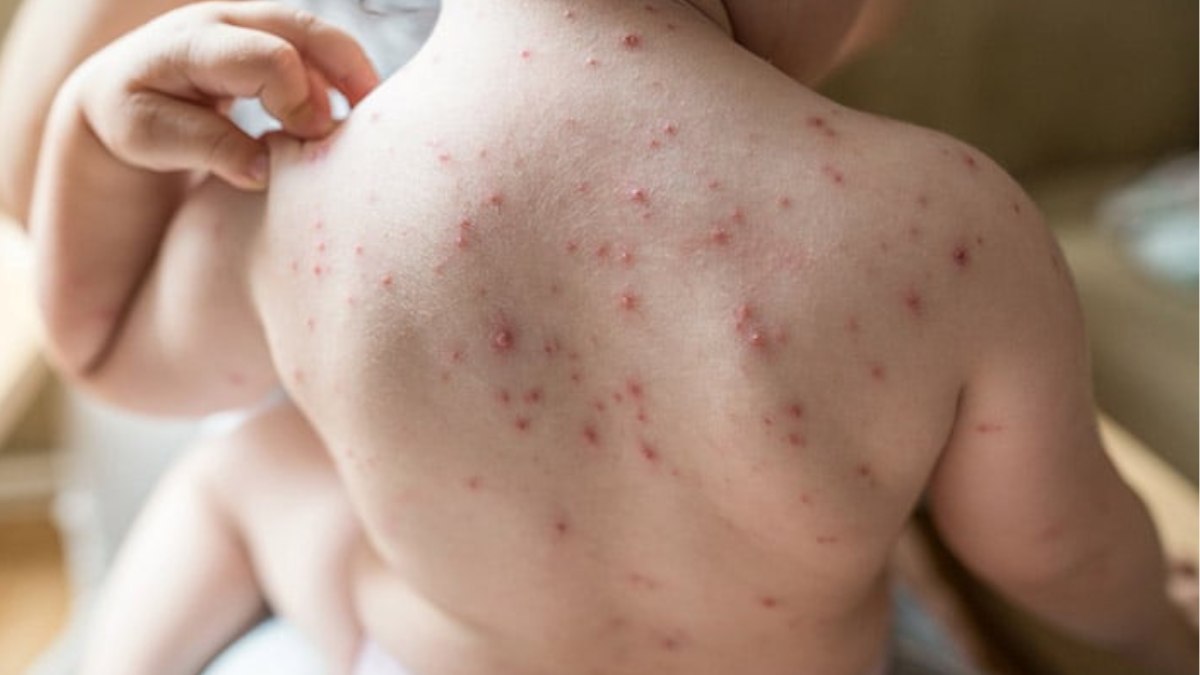 Chicken pox case reported in Kupwara’s Langate Chicken pox case reported in Kupwara’s Langate