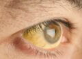 27 Test Positive for Jaundice in Anantnag